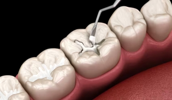 Trám Răng Là Gì? Quy Trình Trám Răng Thẩm Mỹ Chuẩn Y Khoa